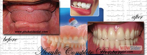 complete-denture01