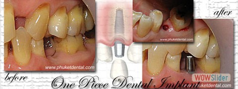 dental_implant01