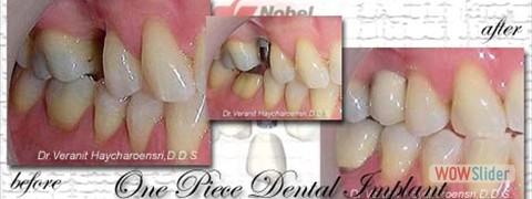 dental_implant010_2