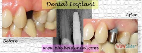 dental implant10