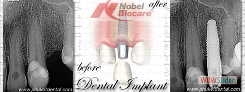 dental_implant_xray06