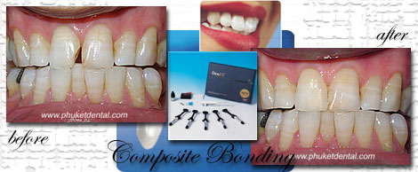 Composite Filing/Dental Bonding