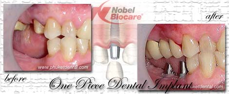 Dental Implants by Phuket Dentist at Phuket Dental Clinic in Phuket,Thailand