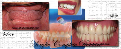 Complete Denture/Partial Dentures at Phuket Dental Clinic in thailand