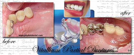 Vitallium Partial Dentures by Phuket Dentist at Phuket Dental Clinic in Phuket,Thailand