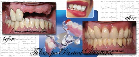 vitallium partial denture:Phuket Dental clinic,Thailand