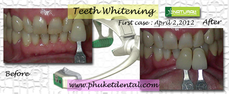 Tooth Whitening:non-LASER,LED,Natural Plus at Phuket Dental Clinic,Thailand