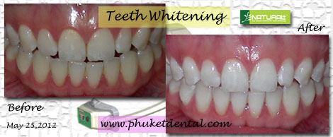 Natural Plus Tooth Whitening in Phuket,Thailand